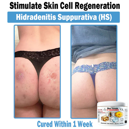 Improvement within 7 days ⏰𝐃𝐨𝐫𝐦𝐨𝐫𝐧𝐚™🌿 𝑩𝒆𝒆 𝑽𝒆𝒏𝒐𝒎 𝑴𝒖𝒍𝒕𝒊-𝑺𝒚𝒎𝒑𝒕𝒐𝒎 𝑺𝒌𝒊𝒏 𝑻𝒓𝒆𝒂𝒕𝒎𝒆𝒏𝒕 𝑪𝒓𝒆𝒂𝒎 (👨‍⚕ Recommended by the AAD) (Clears acne, warts, rosacea, psoriasis, age spots, eczema, and improves skin sagging)