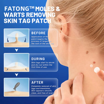 𝐹𝐴𝑇𝑂𝑁𝐺™ Moles & Warts Removing Skin Tag Patch