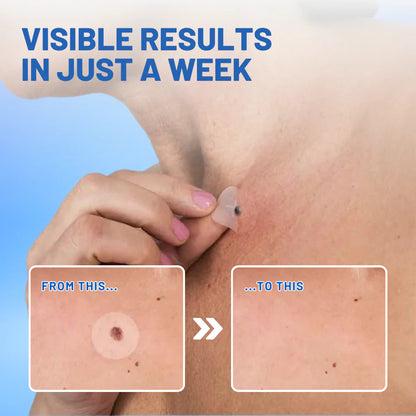 𝐹𝐴𝑇𝑂𝑁𝐺™ Moles & Warts Removing Skin Tag Patch