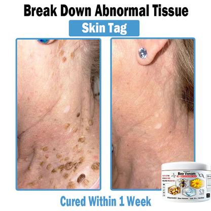 Improvement within 7 days ⏰𝐃𝐨𝐫𝐦𝐨𝐫𝐧𝐚™🌿 𝑩𝒆𝒆 𝑽𝒆𝒏𝒐𝒎 𝑴𝒖𝒍𝒕𝒊-𝑺𝒚𝒎𝒑𝒕𝒐𝒎 𝑺𝒌𝒊𝒏 𝑻𝒓𝒆𝒂𝒕𝒎𝒆𝒏𝒕 𝑪𝒓𝒆𝒂𝒎 (👨‍⚕ Recommended by the AAD) (Clears acne, warts, rosacea, psoriasis, age spots, eczema, and improves skin sagging)